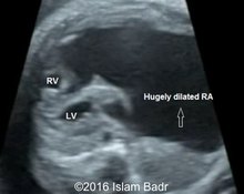 Pulmonary atresia with intact venticular septum image