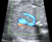 Right aortic arch with left ductus arteriosus image