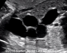 Vesicoureteral reflux - Grade V image