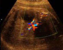 Posterior urethral valves, 35 weeks image