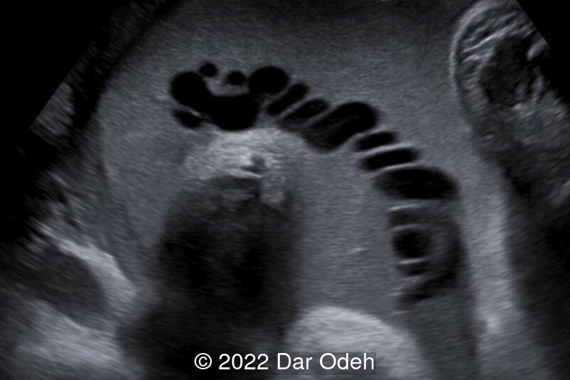 Umbilical cord in gray scale surrounded by highly echogenic amniotic fluid.