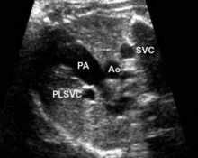 Persistent left superior vena cava causing dilatation of the coronary sinus image