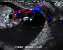 Sacro-lumbar myelomeningocele at 13 weeks image