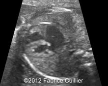 Aortic valve stenosis, endocardial fibroelastosis image