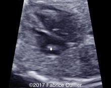 Cardiac rhabdomyoma (isolated) image