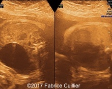 Fetal cystadenoma image