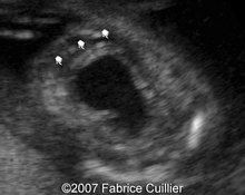 Posterior urethral valves image