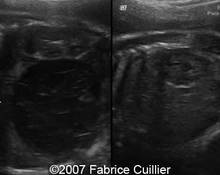 Ovarian cyst image
