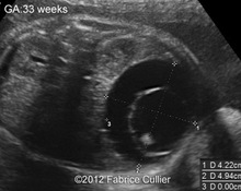 Ovarian Cyst image