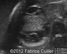 Right ovarian cyst at 35 weeks image