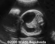 Combined esophageal and duodenal atresias in a fetus with trisomy 21 image