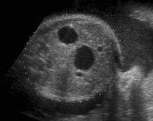 Duodenal atresia image