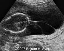 Cystic hygroma, 18 weeks image