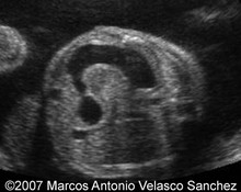 Duodenal atresia image