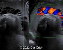 Highly echogenic amniotic fluid image