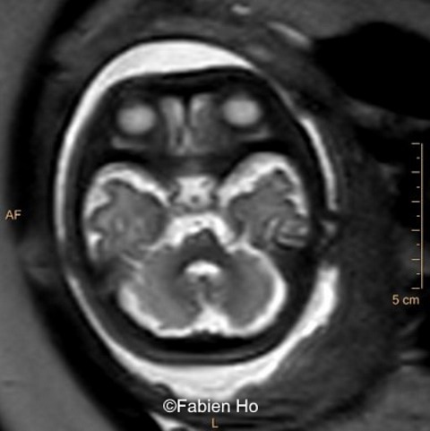 35 weeks gestation