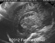 CMV fetopathy image