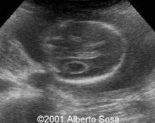 Trisomy 18, diaphragmatic hernia image
