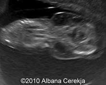Cystic hygroma with single umbilical artery image