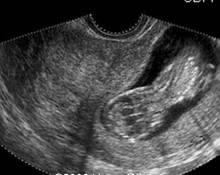 Bicornuate and didelphus uterus image
