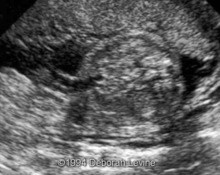 Gastroschisis, left-sided, associated with persistent rightumbilical vein image