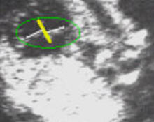 Atrioventricular septal defect image
