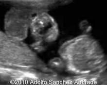 Acrania with bilateral cleft image