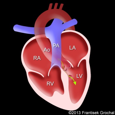 Aorto-ventricular-tunnel_FG_small05