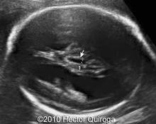 Hydrocephalus due to congenital stenosis of aqueduct of Sylvius, X-linked image