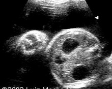 Duodenal atresia image