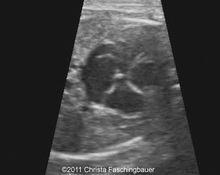 Atrial septal aneurysm image