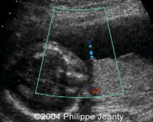Bicornuate uterus, 2nd trimester pregnancy image