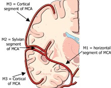 Middle cerebral artery, bilateral early bifurcation image