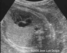 Cystic adenomatoid malformation of the lungs, type II image