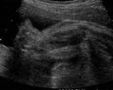 Prenatal ultrasound findings of Smith-Lemli-Opitz syndrome image