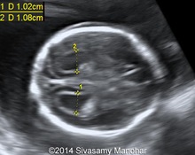 Trisomy 18, two cases image