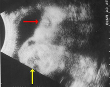 Cervical teratoma image