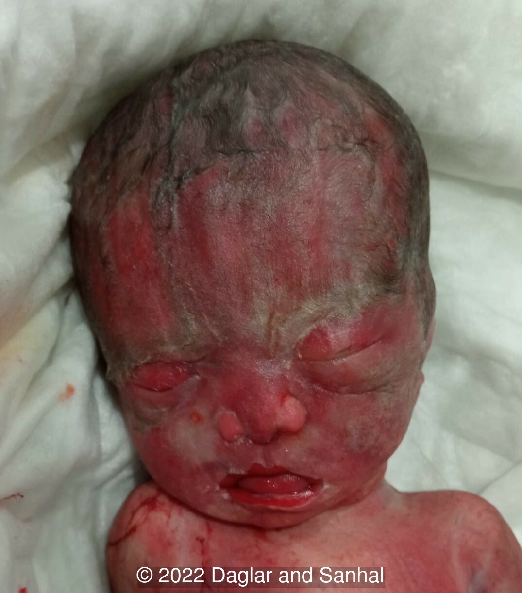 Abnormal fetal face (broad and flattened nose with anteverted nostrils and short philtrum)