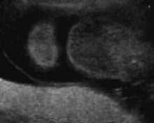 Cystic hygroma, video clip image