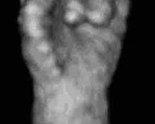 Trisomy 18, clenched fist image