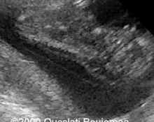 Trisomy 13 at 11 weeks image