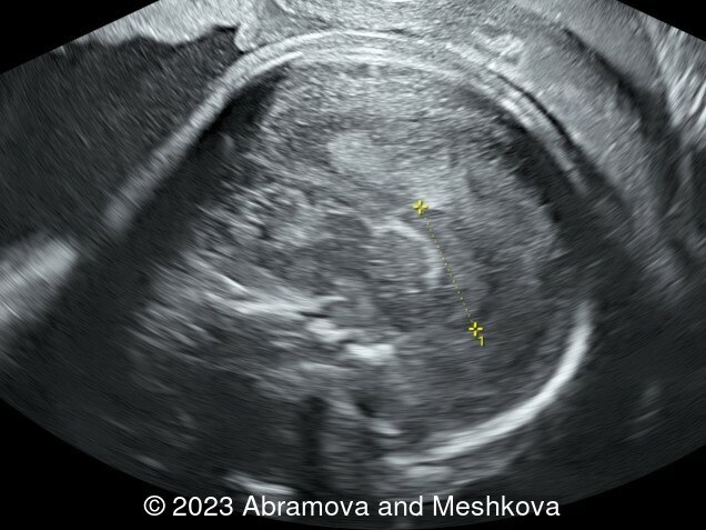 Image obtained at 21-22 weeks of gestation. Distance 1.87 cm