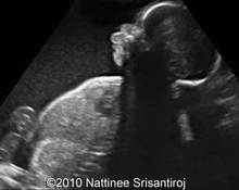 Prenatal cortical hyperosthosis; Caffey disease image