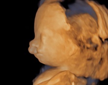 Multiple fetal anomalies, probably trisomy 18 image
