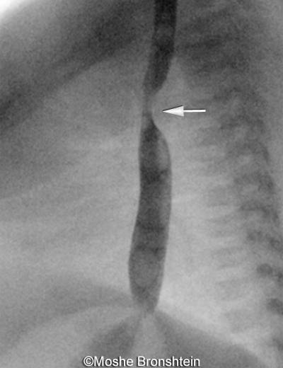 DAA-compression-of-the-esophagus