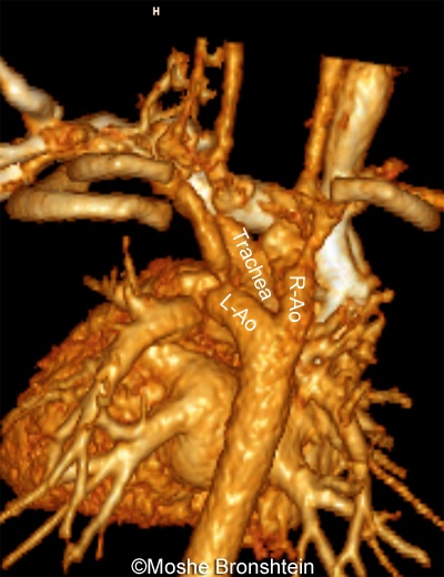 DAA-CT-angio