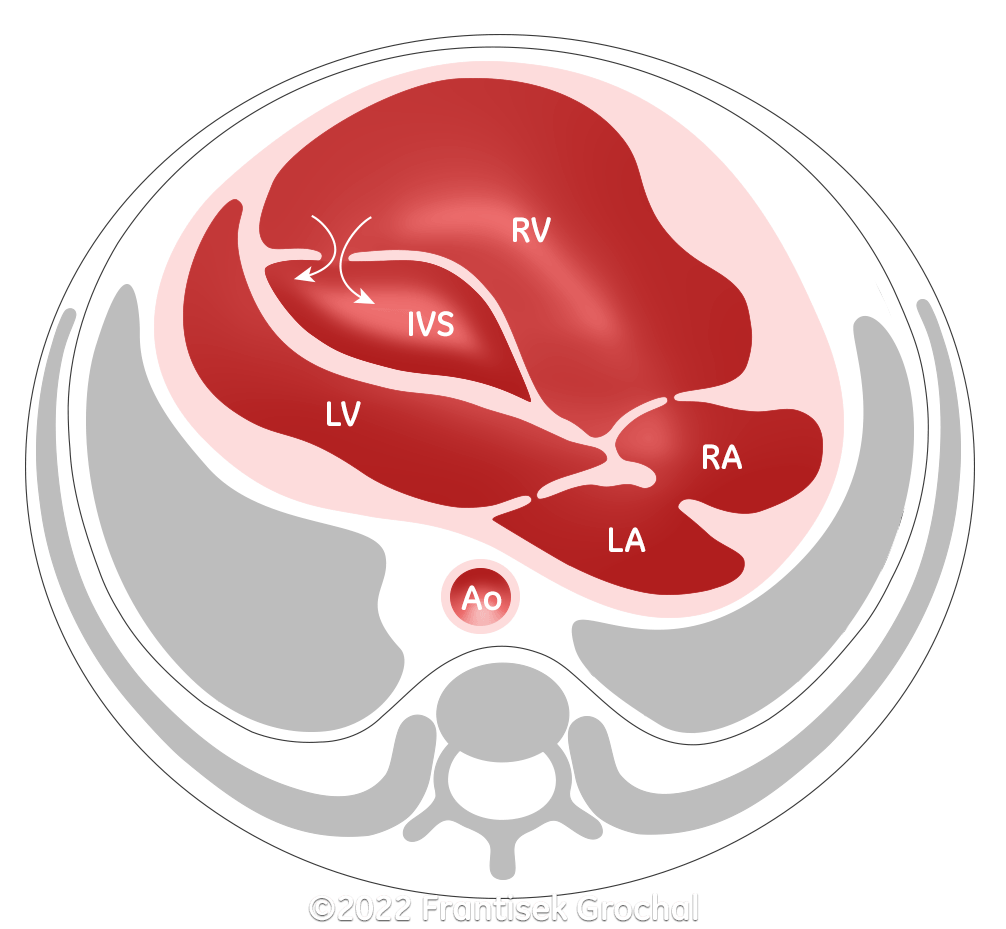 Diagram demonstrating the dissecting aneurysm of the interventricular septum seen in our case. There is a defect in the right wall of the septum which allows blood flow into the interventricular septum. (RV–right ventricle; LV–left ventricle; IVS–