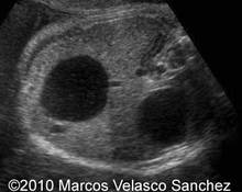 Duodenal atresia image