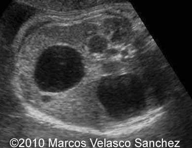 Duodenal_atresia_Marcos_2