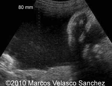 Duodenal_atresia_Marcos_3